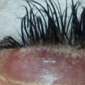 How harmful are eyelash extensions?