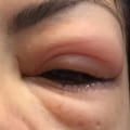 Are there long term effects from eyelash extensions?