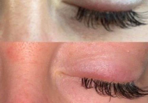 How do you stop an allergic reaction from eyelash extensions?