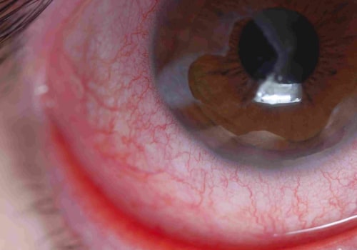 How long do chemical eye burns last?